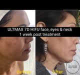 FEB 26 VIP SALE - 'ULTMAX' HIFU Non Surgical Facelift