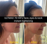 FEB 26 VIP SALE - 'ULTMAX' HIFU Non Surgical Facelift