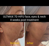 FEB 26 VIP SALE - 'ULTMAX' HIFU Non Surgical Facelift