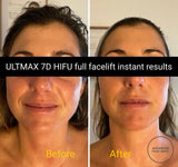 FEB 26 VIP SALE - 'ULTMAX' HIFU Non Surgical Facelift