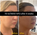 FEB 26 VIP SALE - 'ULTMAX' HIFU Non Surgical Facelift