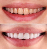 FEB 26 VIP SALE - Professional Teeth Whitening Treatment