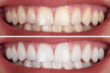 FEB 26 VIP SALE - Professional Teeth Whitening Treatment