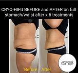 FEB 26 VIP SALE - 'Cyro-HIFU' Body Contouring Treatment
