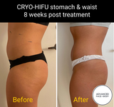 FEB 26 VIP SALE - 'Cyro-HIFU' Body Contouring Treatment