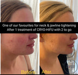 FEB 26 VIP SALE - Neck & Jowl Sculpting Treatment