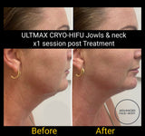 FEB 26 VIP SALE - Neck & Jowl Sculpting Treatment