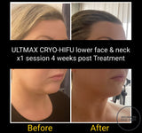 FEB 26 VIP SALE - Neck & Jowl Sculpting Treatment