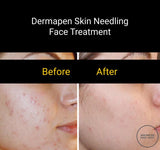 FEB 26 VIP SALE - Dermapen Skin Needling Treatment