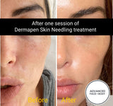 FEB 26 VIP SALE - Dermapen Skin Needling Treatment