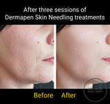 FEB 26 VIP SALE - Dermapen Skin Needling Treatment