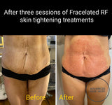 INTRO OFFER - LIMITED TIME FOR FIRST TIME CLIENTS ONLY - FRACELATED RF MICRO-NEEDLING (FACE or BODY)