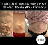 INTRO OFFER - LIMITED TIME FOR FIRST TIME CLIENTS ONLY - FRACELATED RF MICRO-NEEDLING (FACE or BODY)