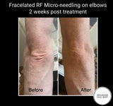 INTRO OFFER - LIMITED TIME FOR FIRST TIME CLIENTS ONLY - FRACELATED RF MICRO-NEEDLING (FACE or BODY)