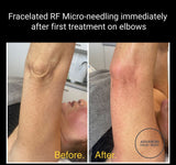 FEB 26 VIP SALE - Fracelated RF Micro-Needling Treatment