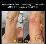INTRO OFFER - LIMITED TIME FOR FIRST TIME CLIENTS ONLY - FRACELATED RF MICRO-NEEDLING (FACE or BODY)