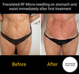 INTRO OFFER - LIMITED TIME FOR FIRST TIME CLIENTS ONLY - FRACELATED RF MICRO-NEEDLING (FACE or BODY)