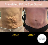 INTRO OFFER - LIMITED TIME FOR FIRST TIME CLIENTS ONLY - FRACELATED RF MICRO-NEEDLING (FACE or BODY)