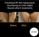 INTRO OFFER - LIMITED TIME FOR FIRST TIME CLIENTS ONLY - FRACELATED RF MICRO-NEEDLING (FACE or BODY)