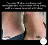INTRO OFFER - LIMITED TIME FOR FIRST TIME CLIENTS ONLY - FRACELATED RF MICRO-NEEDLING (FACE or BODY)