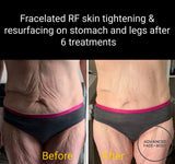 INTRO OFFER - LIMITED TIME FOR FIRST TIME CLIENTS ONLY - FRACELATED RF MICRO-NEEDLING (FACE or BODY)
