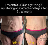 FEB 26 VIP SALE - Fracelated RF Micro-Needling Treatment