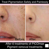 JUNE VIP OFFER - PICOmax Pigment Removal Treatment (Treat Dark Spots, Age Spots & Pigment)