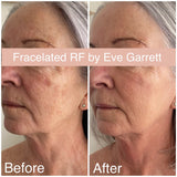 FEB 26 VIP SALE - Fracelated RF Micro-Needling Treatment