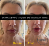 FEB 26 VIP SALE - 'ULTMAX' HIFU Non Surgical Facelift