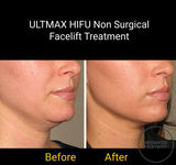 FEB 26 VIP SALE - 'ULTMAX' HIFU Non Surgical Facelift