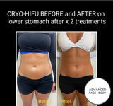 FEB 26 VIP SALE - 'Cyro-HIFU' Body Contouring Treatment