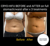 FEB 26 VIP SALE - 'Cyro-HIFU' Body Contouring Treatment