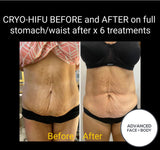 FEB 26 VIP SALE - 'Cyro-HIFU' Body Contouring Treatment