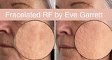 FEB 26 VIP SALE - Fracelated RF Micro-Needling Treatment