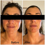 OFFER 'ULTMAX' HIFU Non Surgical Facelift - LIMITED INTRO OFFER FOR FIRST TIME CLIENTS - From $299 (Not $2,999)