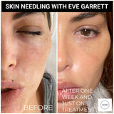 INTRO OFFER Dermapen Skin Needling Treatment for first-time clients