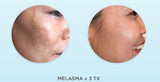 INTRO OFFER Dermapen Skin Needling Treatment for first-time clients