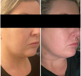 OFFER 'ULTMAX' HIFU Non Surgical Facelift - LIMITED INTRO OFFER FOR FIRST TIME CLIENTS - From $299 (Not $2,999)