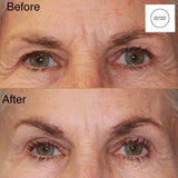 SEPT 26 VIP DEAL - BRIGHT EYES TREATMENT - ANTI-AGING EYE LIFTING FOR YOUR EYES