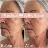 SEPT 26 VIP DEAL - BRIGHT EYES TREATMENT - ANTI-AGING EYE LIFTING FOR YOUR EYES