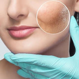 INTRO OFFER Dermapen Skin Needling Treatment for first-time clients