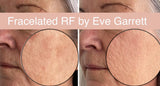 SEPT 26 VIP DEAL - BRIGHT EYES TREATMENT - ANTI-AGING EYE LIFTING FOR YOUR EYES